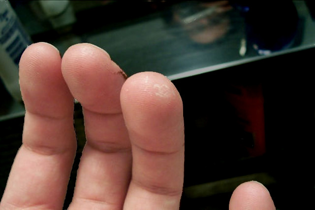 Read more about the article Calluses